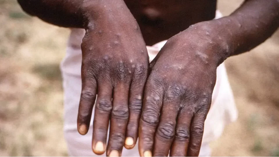 La variole du singe signalée au Maroc: les autorités prennent des mesures de prévention