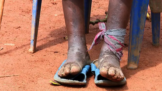 Bénin : Campagne consultations gratuites plaies ulcérations jambe annoncée